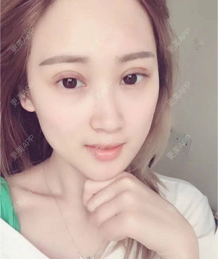 更美 - 刘金丹 医生的定点双眼皮经验 | 定点双眼皮 | 南昌