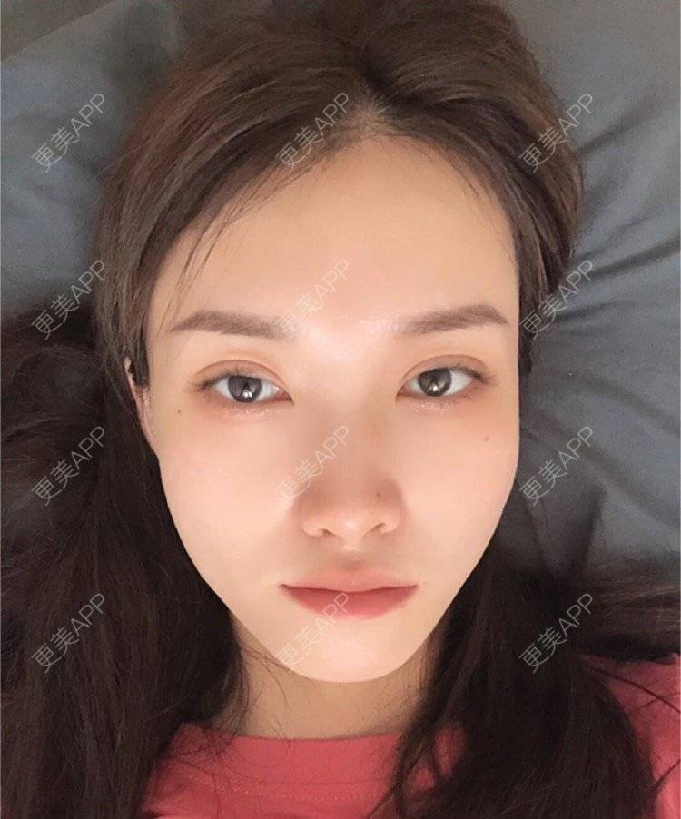 更美 - 心情就像花开花落的定点双眼皮经验 | 定点双眼皮 | 南昌