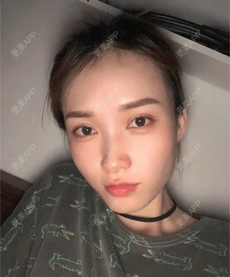 更美 - 心情就像花开花落的定点双眼皮经验 | 定点双眼皮 | 南昌