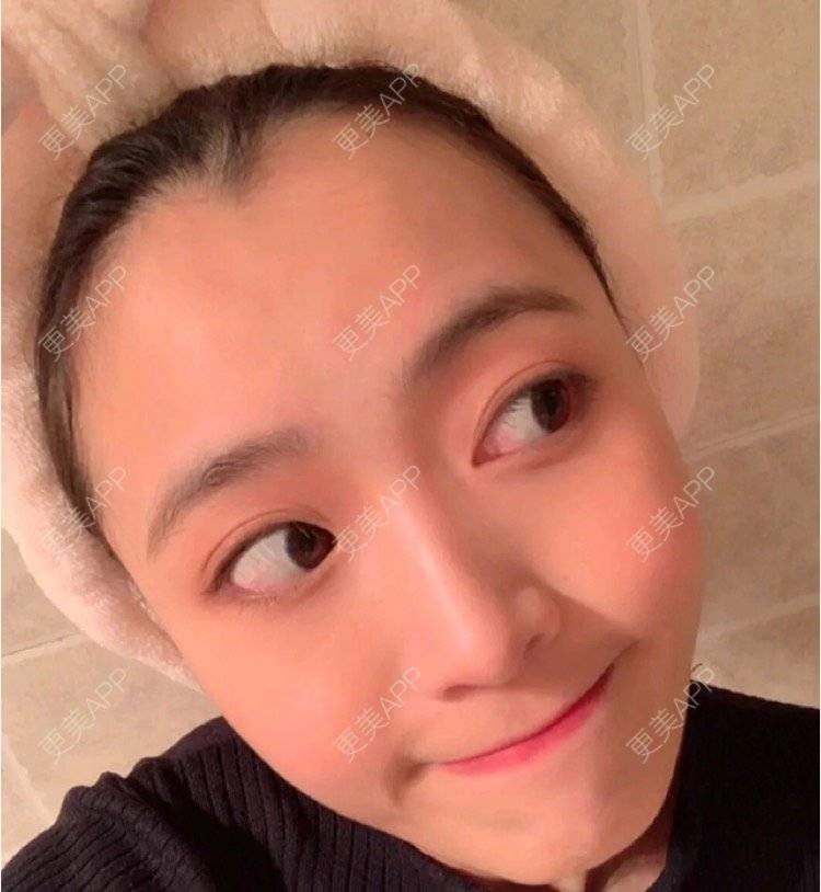 更美 - 心情就像花开花落的定点双眼皮经验 | 定点双眼皮 | 南昌
