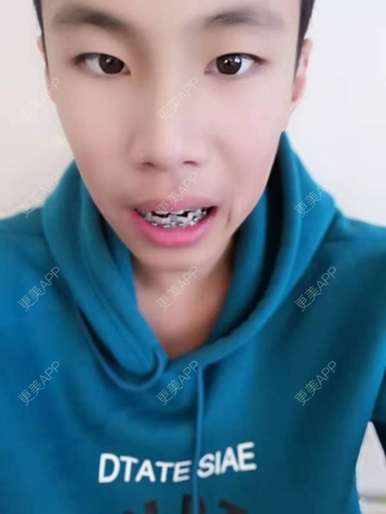 更美 - 赵鹏 医生的牙齿矫正经验 | 牙齿矫正
