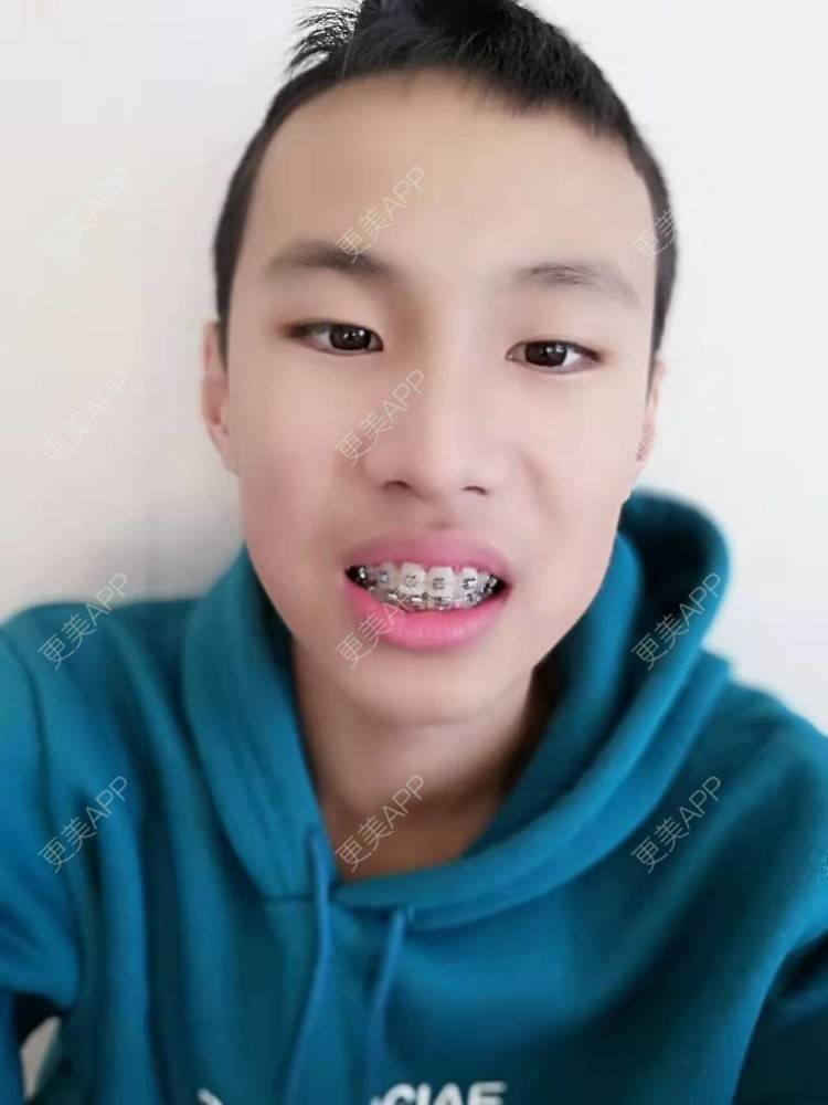 更美 - 赵鹏 医生的牙齿矫正经验 | 牙齿矫正