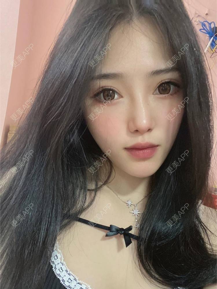 更美 - 李晨阳 医生的超声提升经验 | 杭州 | 超声提升