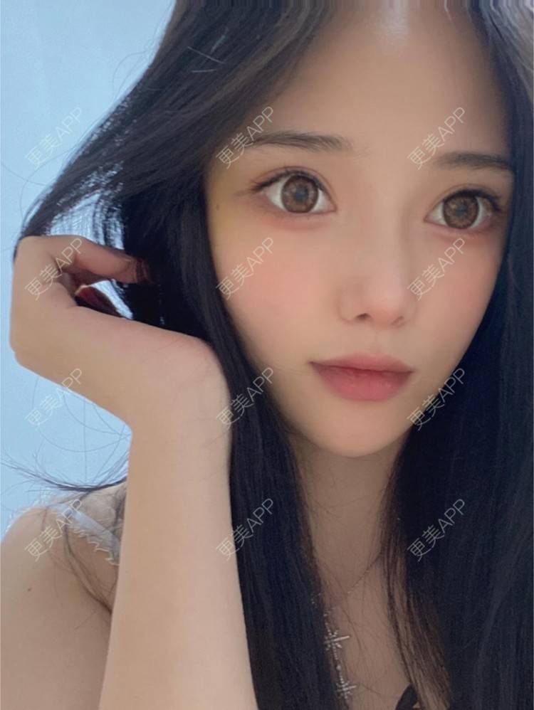 更美 - 李晨阳 医生的超声提升经验 | 杭州 | 超声提升