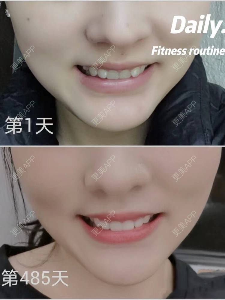 更美 - 李晨阳 医生的金属托槽矫正经验 | 金属托槽矫正 | 杭州