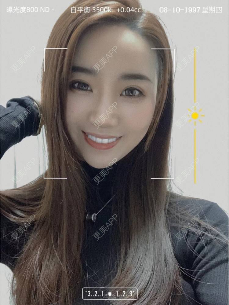 更美 - 李晨阳 医生的金属托槽矫正经验 | 杭州 | 金属托槽矫正