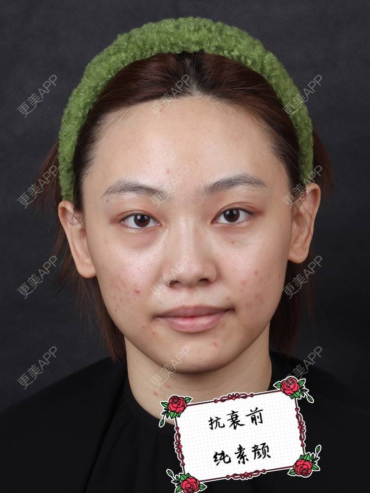 更美 - 李晨阳 医生的热玛吉经验 | 热玛吉 | 杭州