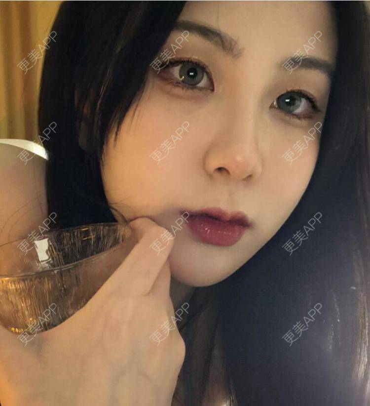 更美 - 张瀚博 医生的玻尿酸经验 | 玻尿酸