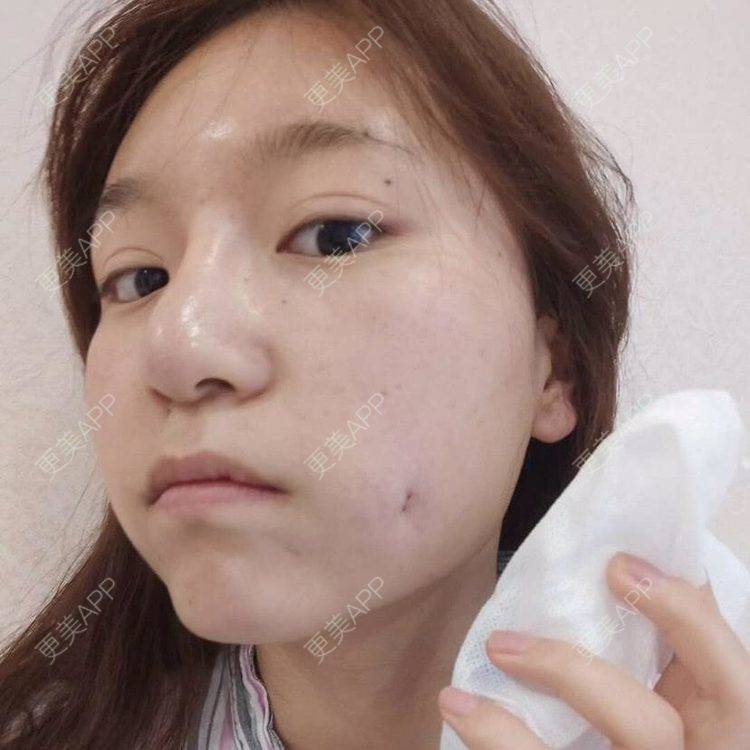 更美 - 更美用户cqbqrhrcq4的埋线酒窝日记 | 埋线酒窝