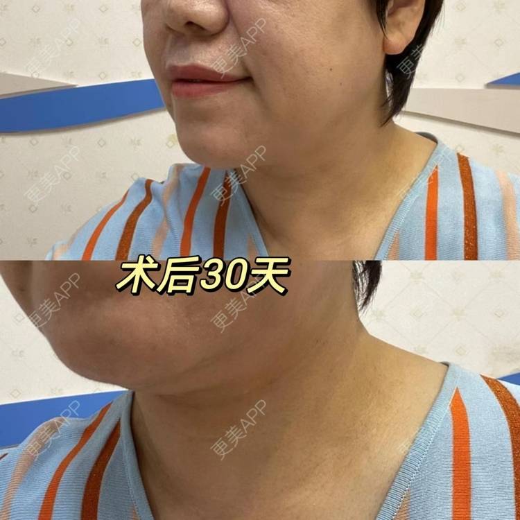 更美 - 吴华 医生的微针水光经验 | 微针水光