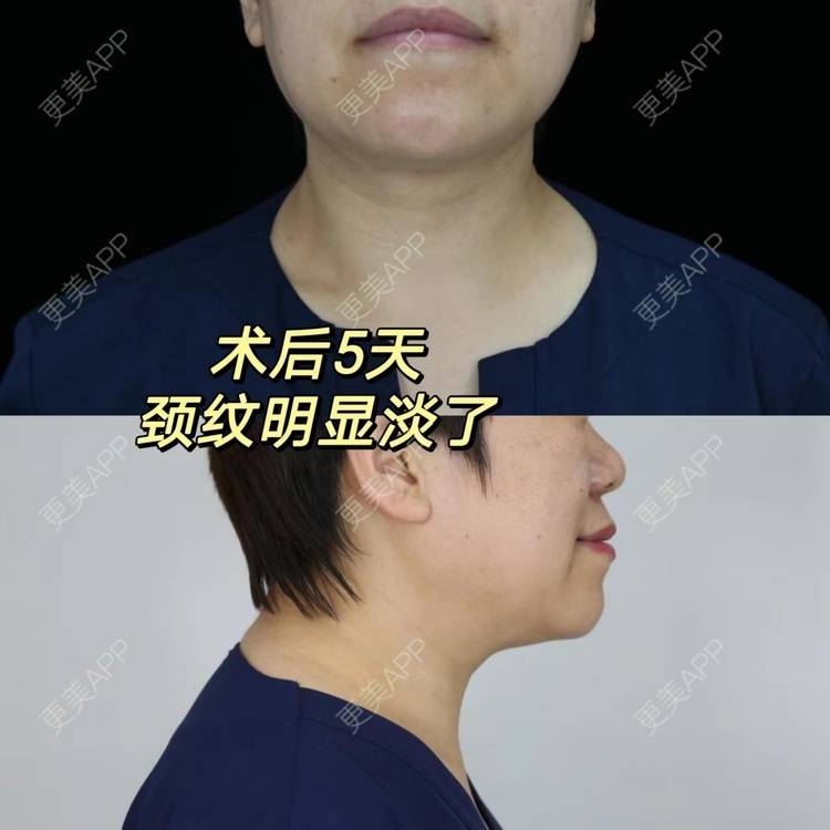 更美 - 吴华 医生的微针水光经验 | 微针水光