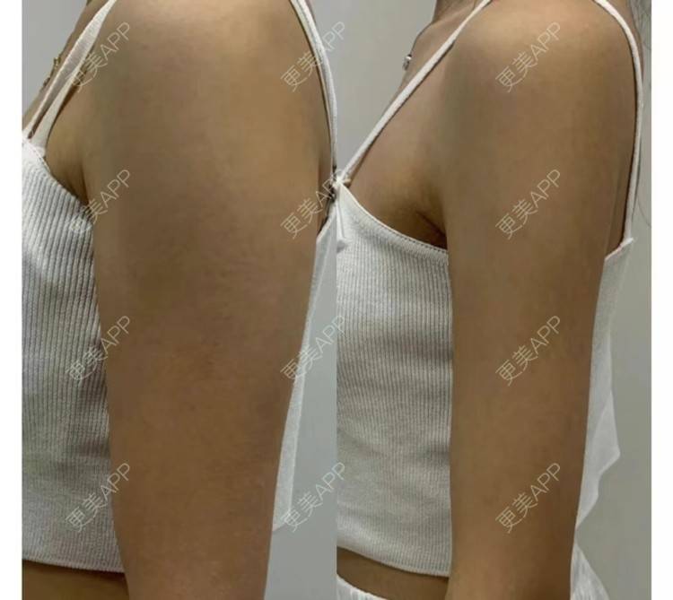 更美 - 长春医维格医疗美容有限公司朝阳医维格医疗美容门诊部的水动力吸脂术经验 | 合肥 | 水动力吸脂术