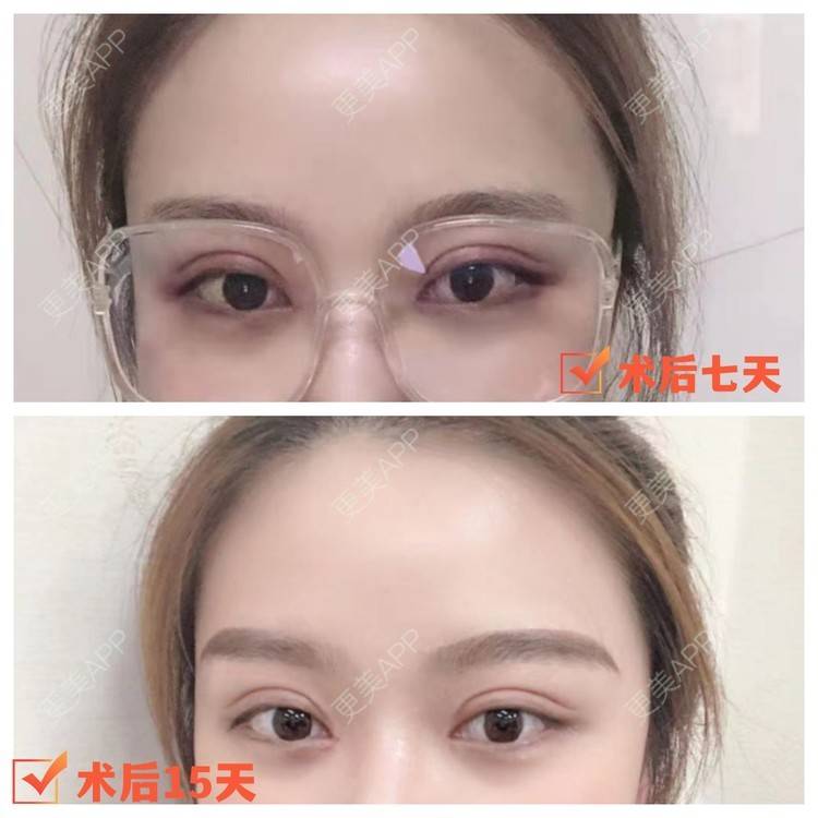更美 - 叶斌 医生的全切双眼皮经验 | 全切双眼皮