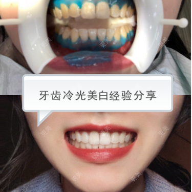 A-ling豆子