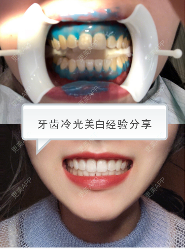 更美 - 有生之年终于获得一口大白牙 | 明星整形 | 牙齿美白 | 冷光牙齿美白