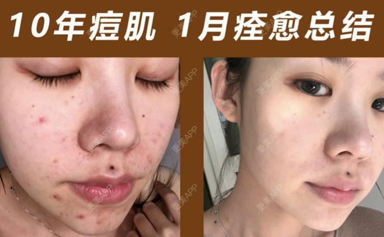 更美 - 与痘痘抗争到底❗️ | 祛痘 生活美容 | ipl祛痘