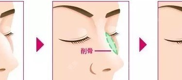 驼峰鼻矫正