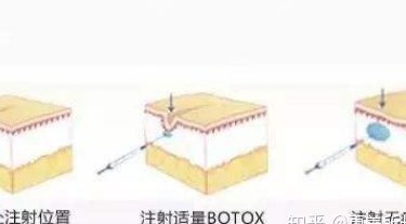 祛腋臭